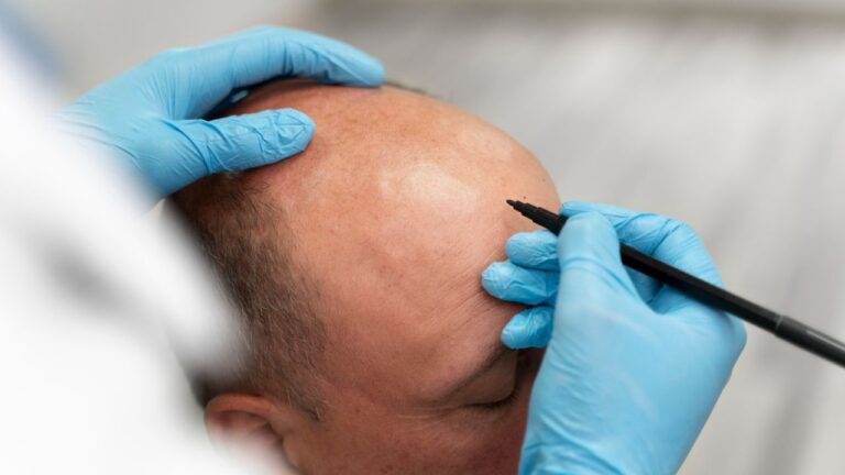 Turkey for Hair Transplants