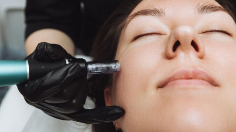 Is Microneedling in Cambridge Right for Your Skin Concerns Microneedling in Cambridge